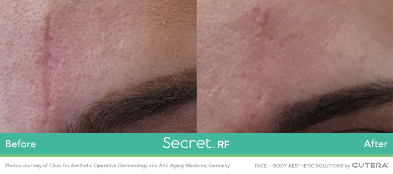 Secret RF Results Photo - Low Country Dermatology - Savannah, GA